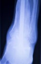 Xray foot heel ankle scan