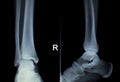 Xray foot heel ankle scan