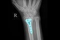 Xray of a forearm of a patient with fractured wrist bones after surgery