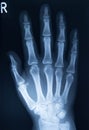 Xray of hand bones, right hand