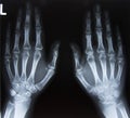 Carpal bones Human X Ray Royalty Free Stock Photo