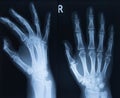 X-ray of both hands