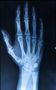 Xray of Hand/ fingers Royalty Free Stock Photo