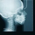 Xray of the head of a child or kid side view Royalty Free Stock Photo