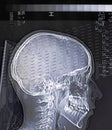 Xray head scan of a person Royalty Free Stock Photo