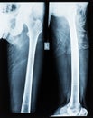 Xray of hip joint Royalty Free Stock Photo