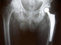 Xray of Hip Replacement Royalty Free Stock Photo