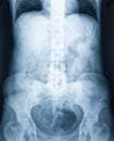 Xray of a human abdomen