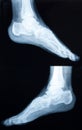 Xray of a human ankle