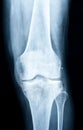 Xray of a human knee