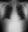 Xray of a human thorax Royalty Free Stock Photo