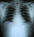 Xray of a human thorax chest Royalty Free Stock Photo