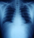 Xray of a human thorax chest