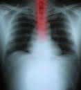 Xray of a human thorax with esophagus highlighted Royalty Free Stock Photo