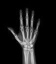 xray image of both hand AP view isolated on black  background  for diagnostic rheumatoid Royalty Free Stock Photo