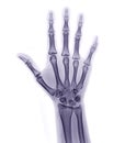 xray image of both hand AP view isolated on white background  for diagnostic rheumatoid Royalty Free Stock Photo
