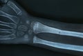 Xray image of a broken hand Royalty Free Stock Photo