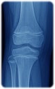 Xray of the knee