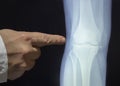 An xray of a knee with a doctor`s hand Royalty Free Stock Photo