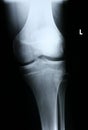 Xray/Knee front Royalty Free Stock Photo