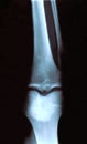 Xray of a Knee - front view