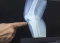 An xray of a knee with a doctor`s hand