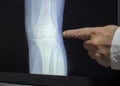 An xray of a knee with a doctor`s hand Royalty Free Stock Photo