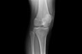 Xray Knee Joints of an Adolescent