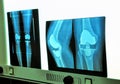 Xray knee prosthesis Royalty Free Stock Photo