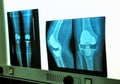 Xray knee prosthesis