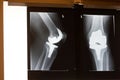 Xray knee replacement