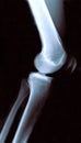 Xray of a Knee - side view