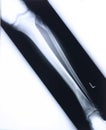 Xray/leg Royalty Free Stock Photo