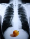 Xray/lung 2 Royalty Free Stock Photo