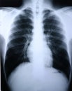 Xray/lung Royalty Free Stock Photo