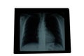 Xray lungs radiological image of patient lung parenchyma homogeneous radiographic pattern and aortic button prominence Royalty Free Stock Photo