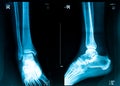 Xray picture Royalty Free Stock Photo