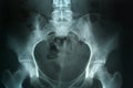 Xray picture pelvis