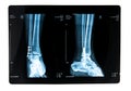 Xray picture Royalty Free Stock Photo