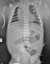 Xray placement umbilical catheter in neonates