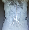 Xray posterior harrington rod spinal vertebrae pathology