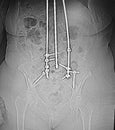 Xray posterior harrington rod spinal vertebrae pathology