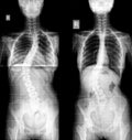 Xray of scoliosis human