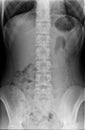 Xray Spine and Pelvis of a Human Body Royalty Free Stock Photo