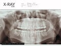 Xray teeth mouth dental tomography. Vector X-ray radiology oral panorama. Medical skeleton x ray background.