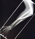 Xray upper extremity fracture monteggia