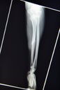 Xray upper extremity fracture monteggia