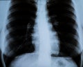 XRay of a woman`s chest