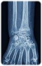 Xray of the wrist