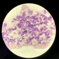 Yeast cells phagocytosis by white blood cell in blood smear